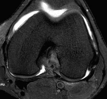 ACL Femoral Avuslion MRI